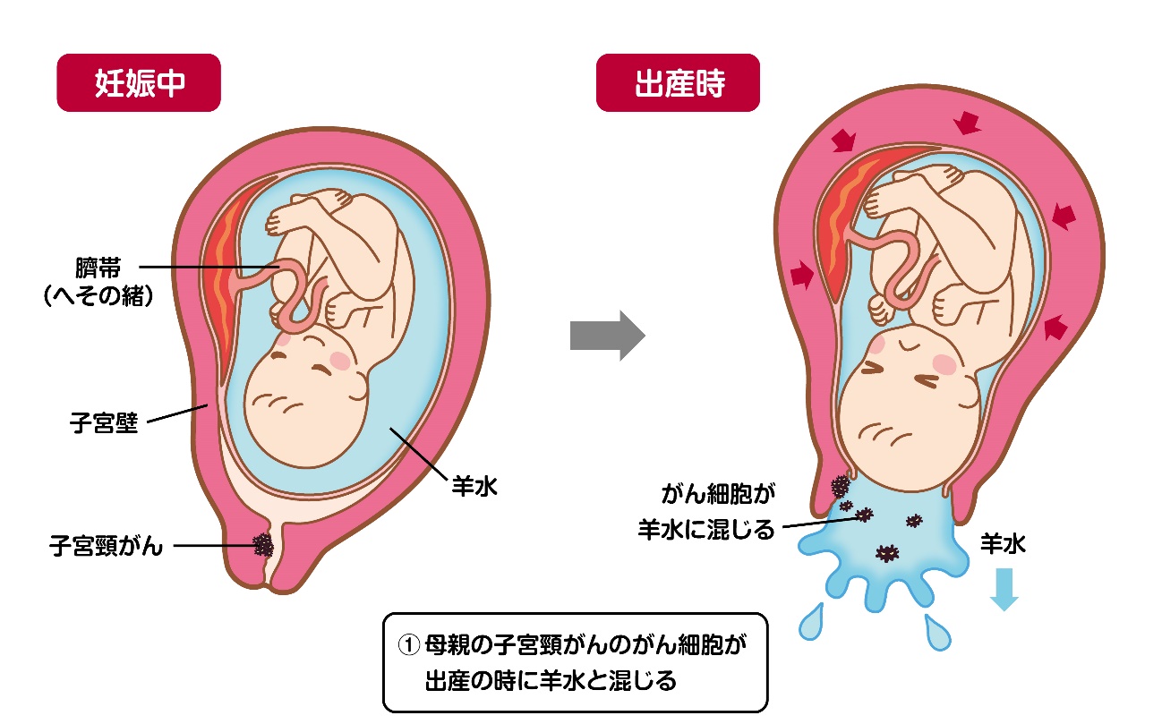 図2a  母親の子宮頸がんのがん細胞が羊水と混じる