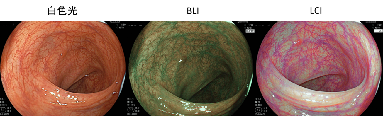 大腸内視鏡検査_図1