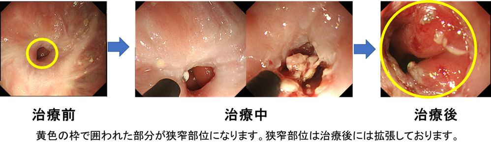 図6内視鏡的食道狭窄解除術（RIC）