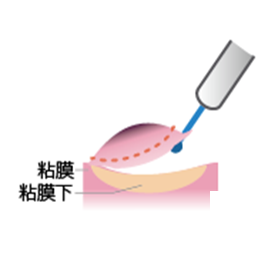 図2-4内視鏡的粘膜下層剥離術(ESD)
