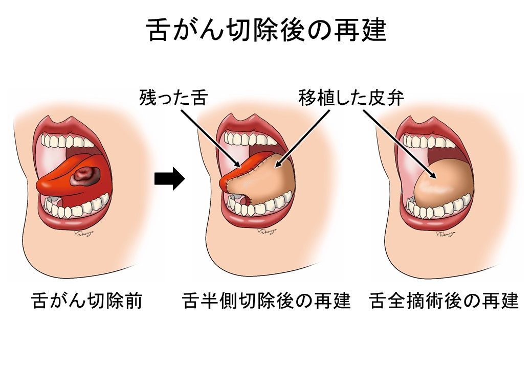 舌がん切除後の再建の図