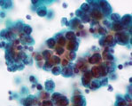 胸水中の腺癌細胞画像