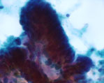 大腸腺癌細胞画像