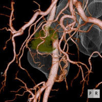 最新の画像ワークステーションを使用し、術前のCTから腸管、血管、がん、リンパ節を一つの立体的な画像1