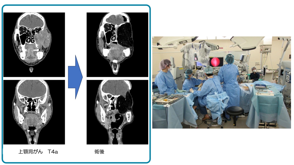 図2 ：進行上顎洞がん　頭蓋底手術症例のCT（左）、頭蓋底手術の様子（右）