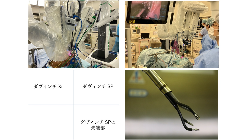 図3：ダヴィンチを用いた経口的ロボット支援手術（TORS= Transoral robotic surgery）の様子