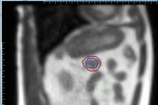 照射位置(赤)に病巣(青)が入っており、放射線が照射される