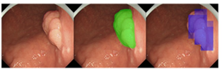 Fig. Automatic detection of early gastric cancer  in endoscopic images