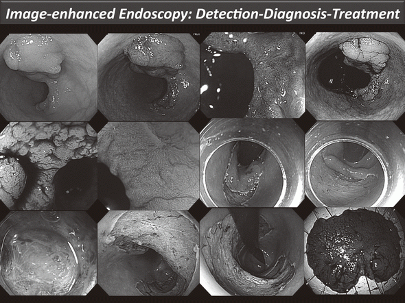 Figure 1. Endoscopic diagnosis using image-enhanced endoscopy (high-resolution endoscopy, narrow-band imaging and chromoscopy) and endoscopic submucosal dissection (ESD) procedure for treating early colon cancer