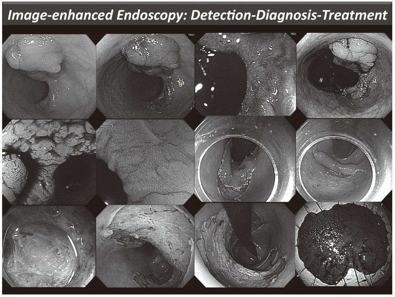 Figure 1. Endoscopic diagnosis using image-enhanced endoscopy (high-resolution endoscopy, narrow-band imaging and chromoscopy) and endoscopic submucosal dissection (ESD) procedure for treating early colon cancer(Full Size)