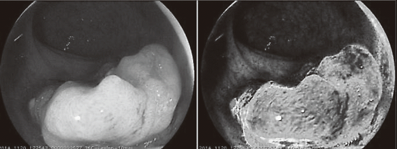 Figure 1.  Oxygen saturation imaging of rectal cancer