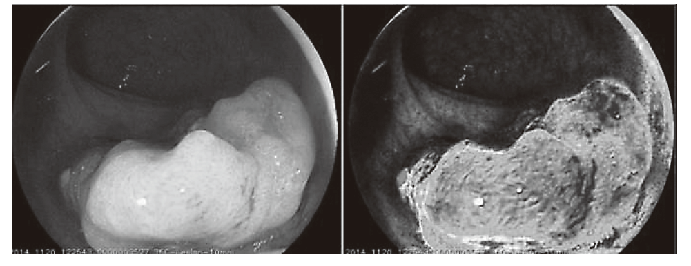 Figure 1. Oxygen saturation imaging of rectal cancer(Full Size)