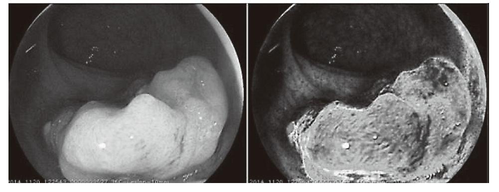 Figure 1.  Oxygen saturation imaging of rectal cancer(Full Size)