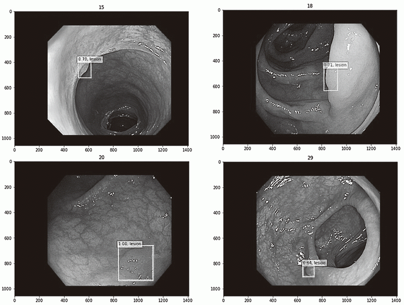 Figure 2.  Detection of small colorectal lesions by using diagnostic artificial intelligence (AI) system
