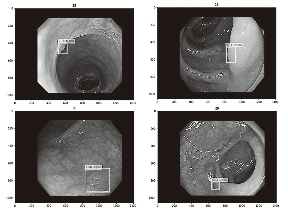 Figure 2.  Detection of small colorectal lesions by using diagnostic artificial intelligence (AI) system(Full Size)