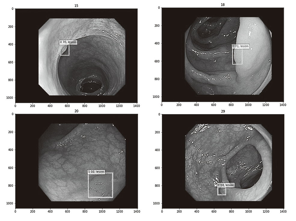Figure 2. Detection of small colorectal lesions by using diagnostic artificial intelligence (AI) system(Full Size)