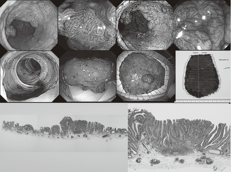 Figure 1. Endoscopic diagnosis using image-enhanced endoscopy (high-resolution endoscopy, narrow-band imaging and chromoscopy) and endoscopic submucosal dissection (ESD) procedure for treating early colon cancer