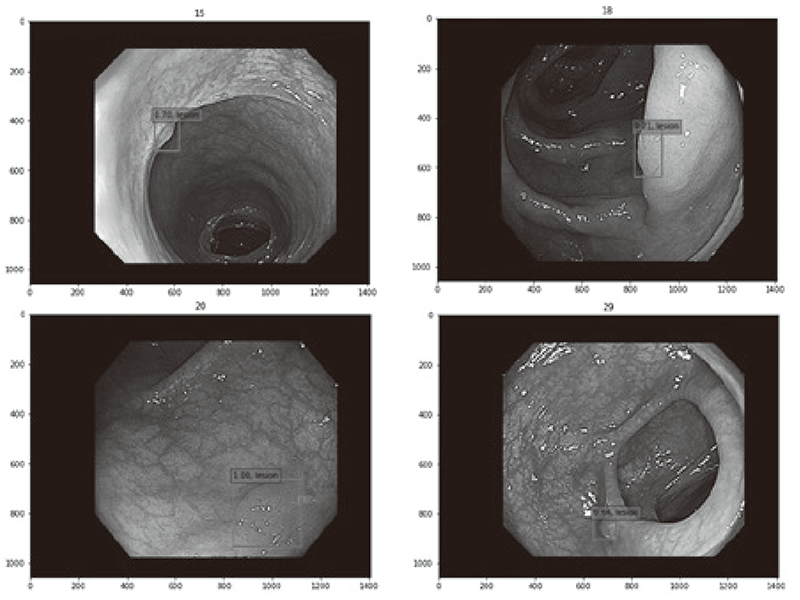 Figure 1. Detection of small colorectal lesions by
using diagnostic AI system