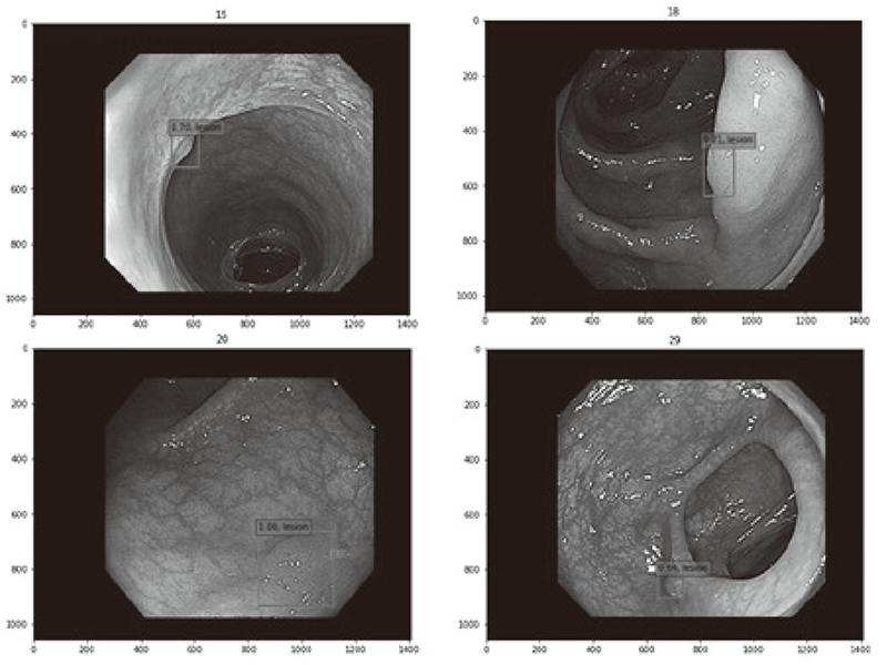 Figure 1. Detection of small colorectal lesions by
using diagnostic AI system(Full Size)