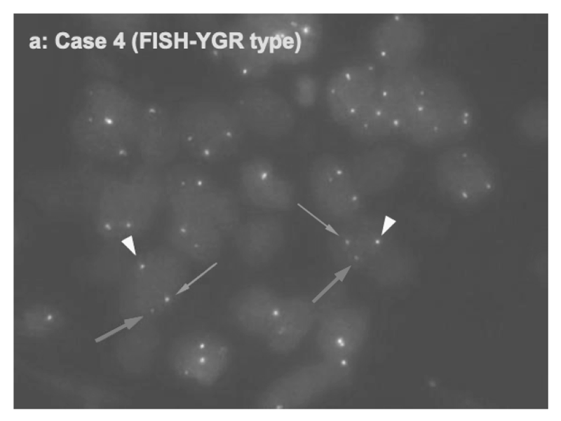 Figure 1.Detection of FGFR2 fusion in a cholangiocarcinoma case by FISH