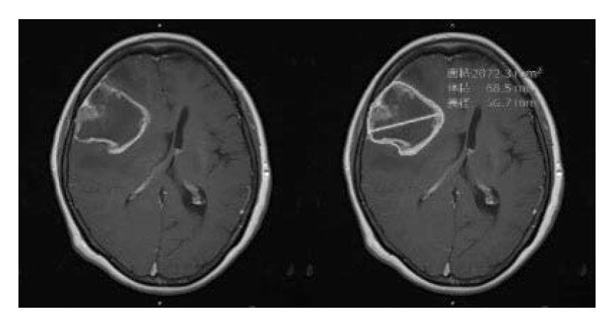 Figure. Example of results of extracting areas suspected of being glioma using AI technology developed through joint research with Fujifilm.