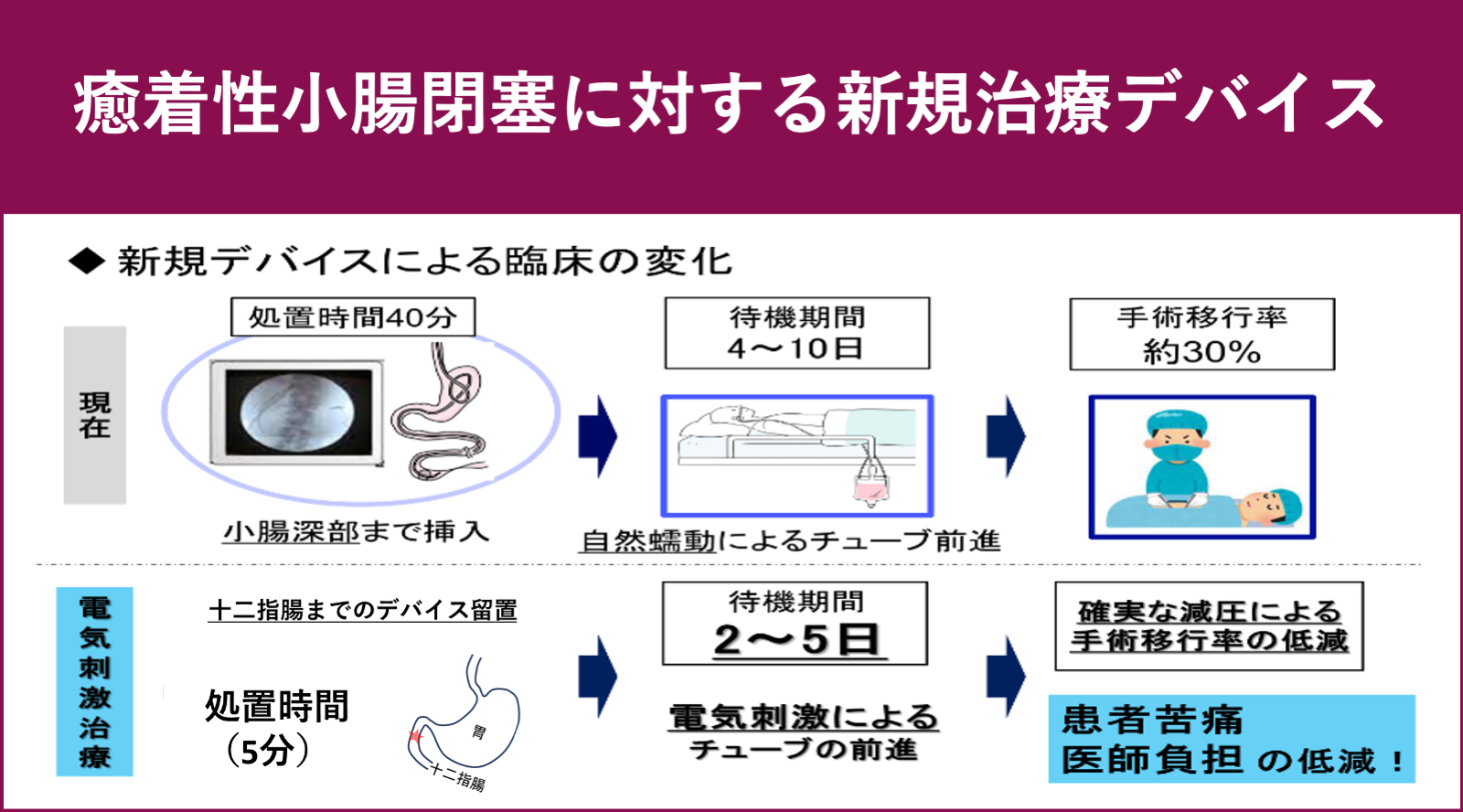 癒着性小腸閉塞に対する新規的治療デバイスの開発