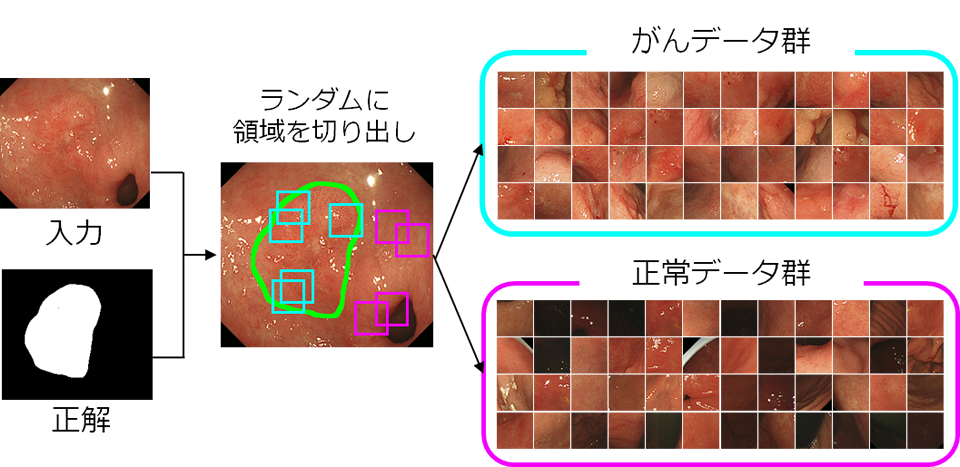 早期胃がんの正解画像からランダムに切り出した「がん」と「正常」の学習用画像