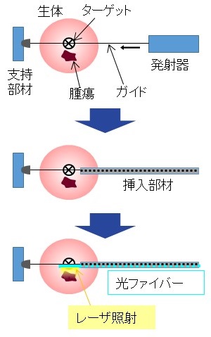 新規穿刺焼却デバイスの特徴(特願2017-508444)図