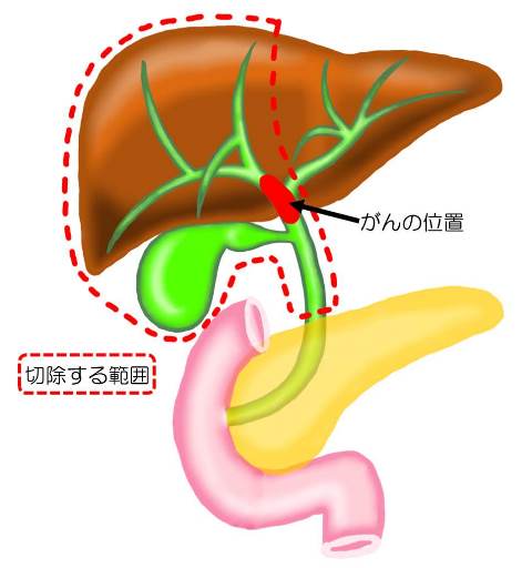 bile_duct_cancer02.jpg