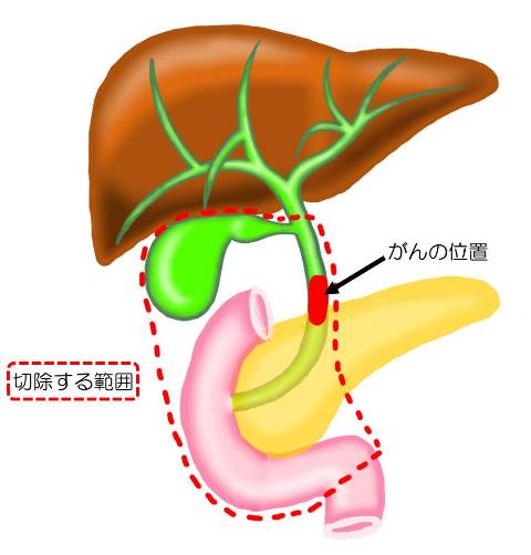 bile_duct_cancer03.jpg