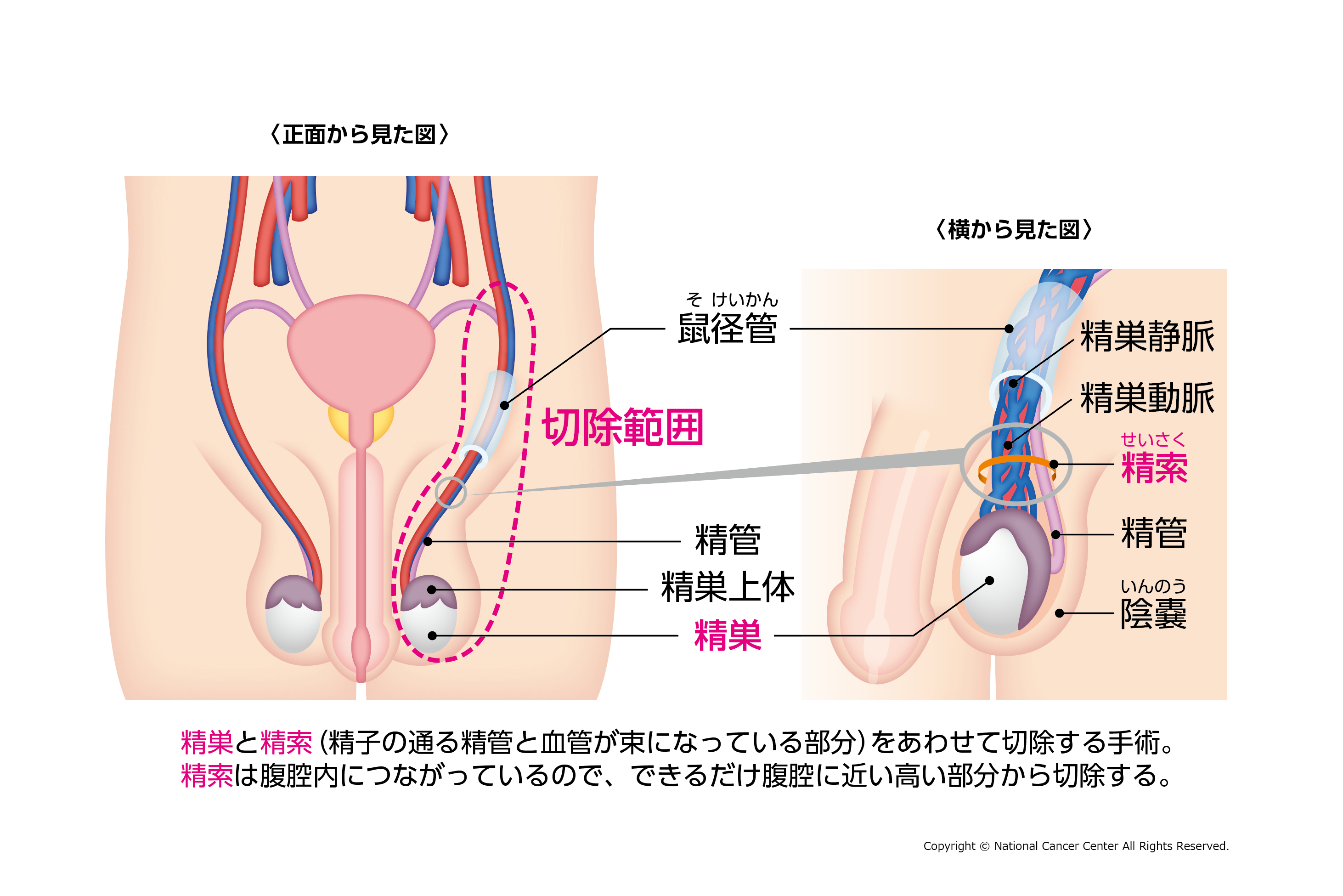 testicular_004.png