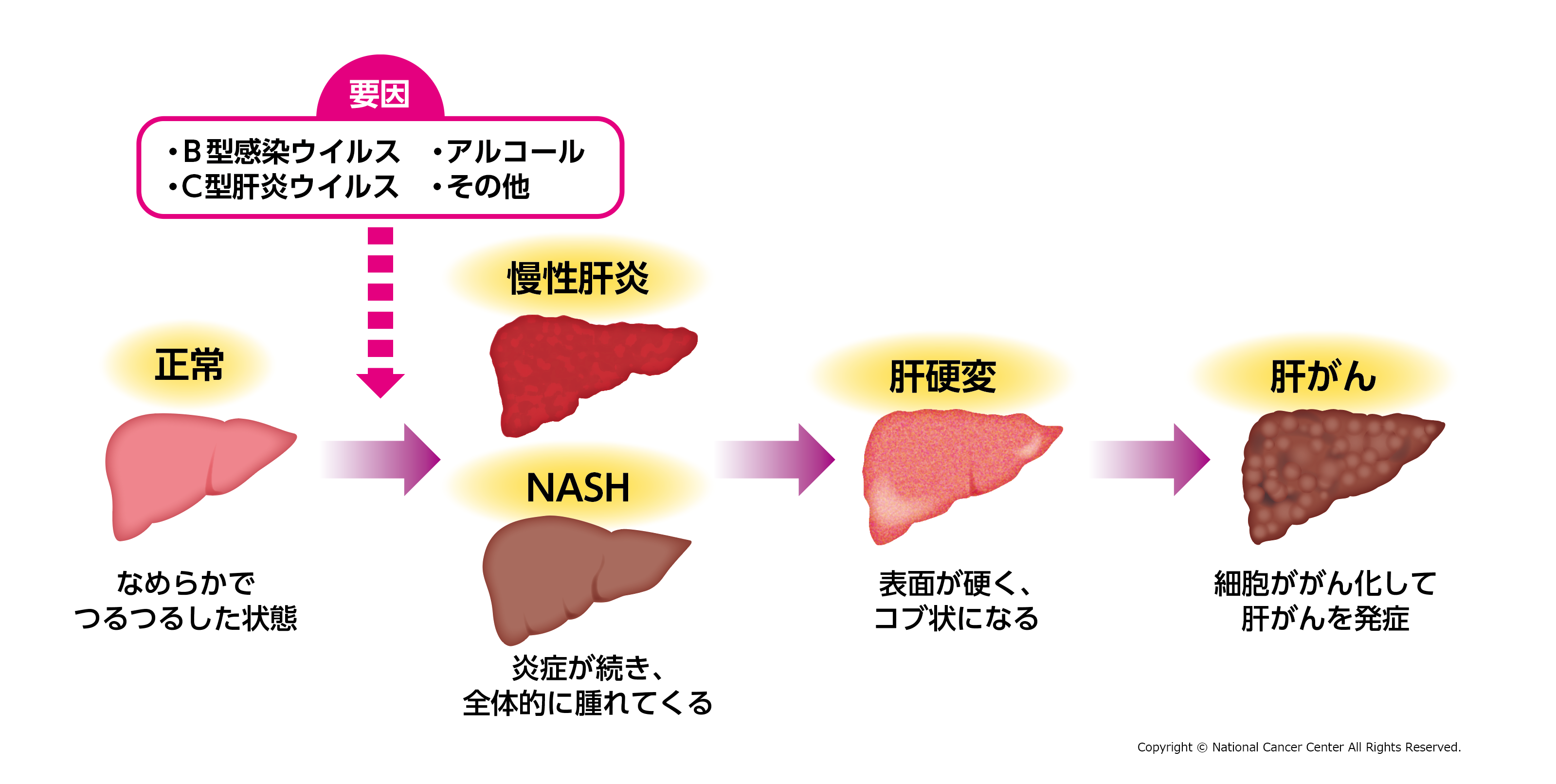 肝がんの原因　肝臓の経過