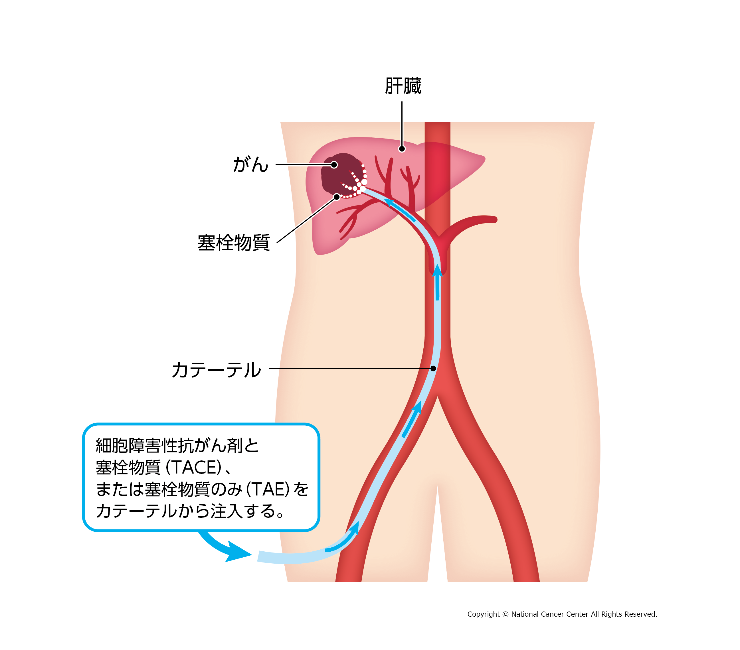 肝動脈化学塞栓療法（TACE）