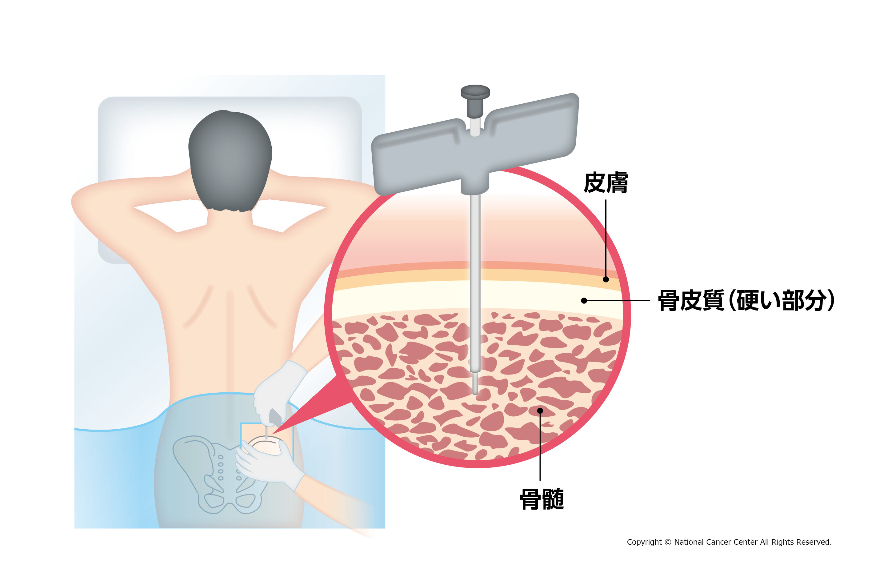 multiplemyeloma4.png