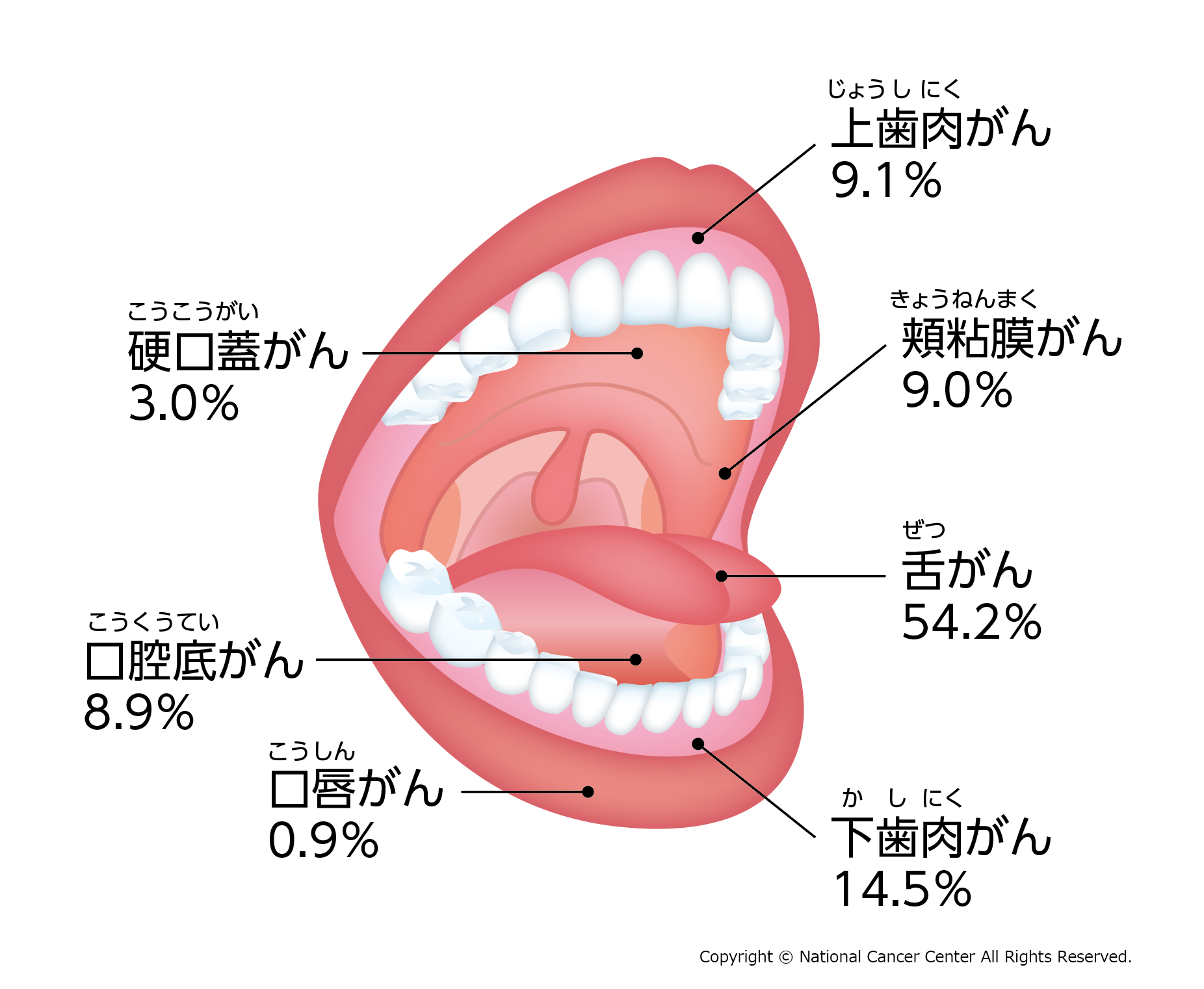 軟口蓋がんはどのようなものですか?