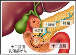 十二指腸乳頭部（ファーター乳頭部）がんの画像