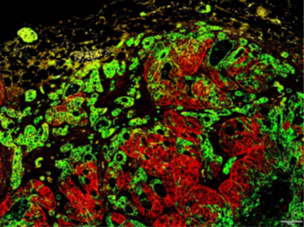ヒトの大腸がんにみられたがん幹細胞マーカーを発現する細胞