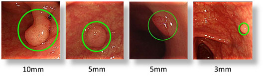 ポリープ検出の例の画像