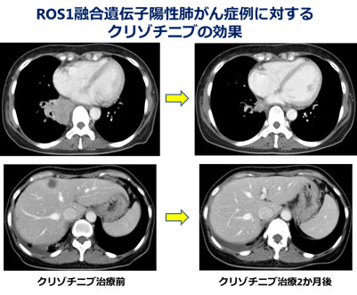 ROS1融合遺伝子陽性肺がん症例に対するクリゾチニブの効果　画像