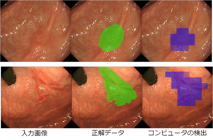図　医師の診断（緑）とコンピュータの自動検出（紫）が示した早期胃がんの領域