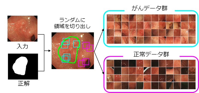 図1 早期胃がんの正解画像からランダムに切り出した「がん」と「正常」の学習用画像