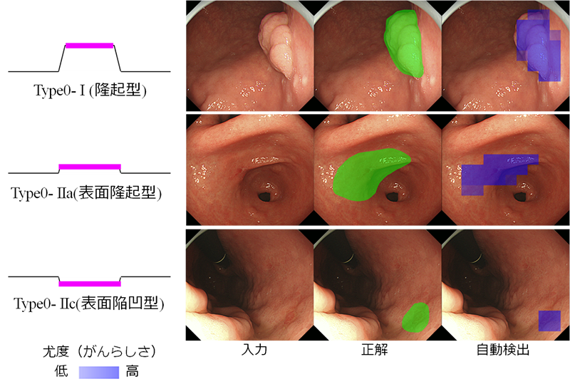 図2 タイプ別の早期胃がんの自動検出例
