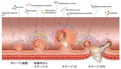 メタゲノム・メタボローム解析により大腸がん発症関連細菌を特定