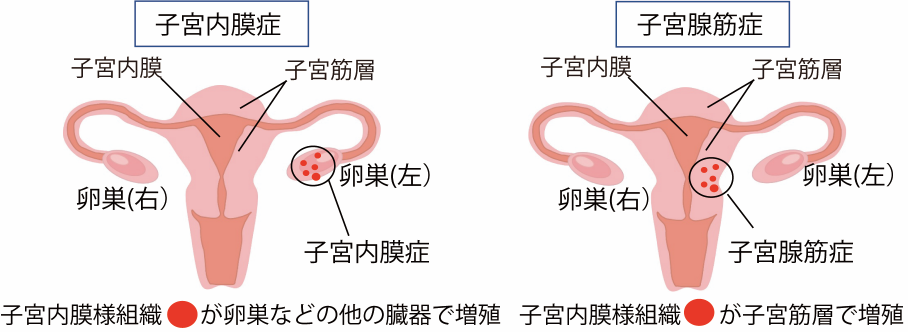 子宮腺筋症のゲノム解析図１