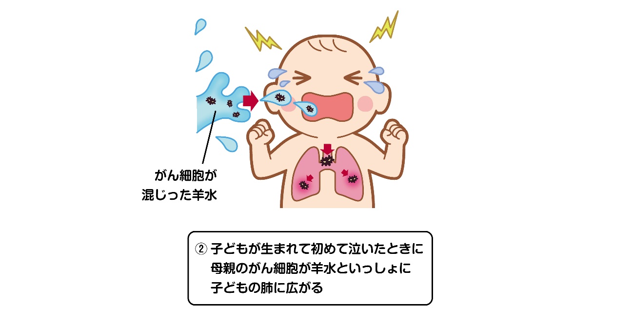 図2b 子どもが泣いたときにがん細胞が肺に入る