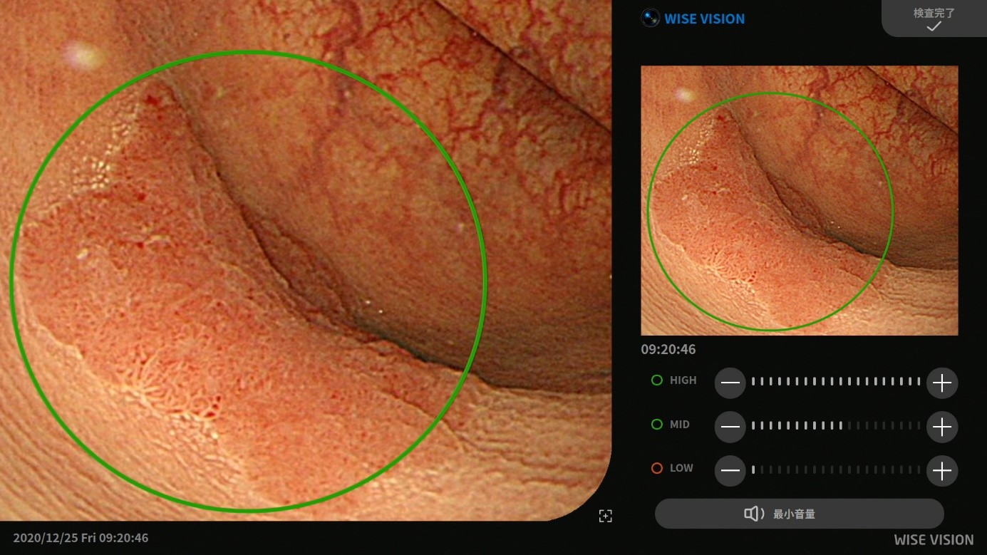 「WISE VISION 内視鏡画像解析AI」を用いた大腸癌検出の例