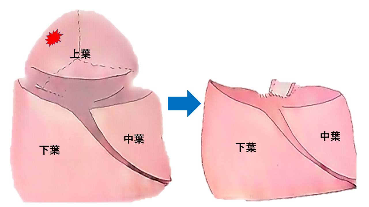 標準手術（肺葉切除）