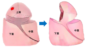 区域切除