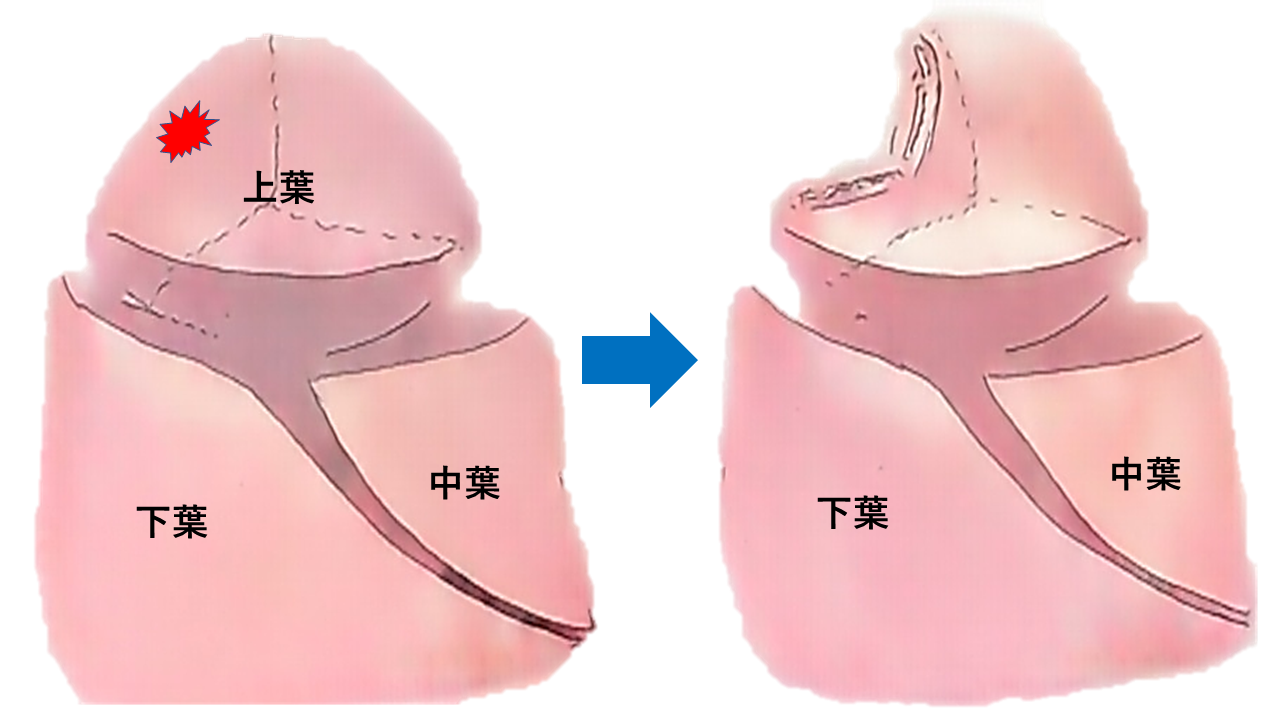 ・楔状切除(部分切除