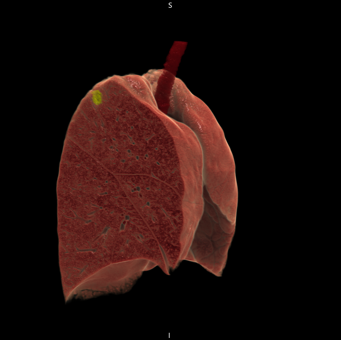 全肺野3D画像(黄色部が病変